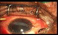 Removal of Multiple Foreign Bodies from Single Eye with Successful Visual Recovery