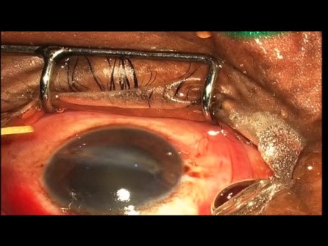 Removal of Multiple Foreign Bodies from Single Eye with Successful Visual Recovery
