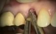 Upper Right Premolar Implant Microsurgery
