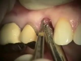 Upper Right Premolar Implant Microsurgery