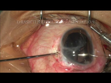Omnifit Scleral Tuck Lens