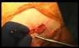Closure in Primary Total Hip Arthroplasty via Anterior Supine Approach, Dr Berend