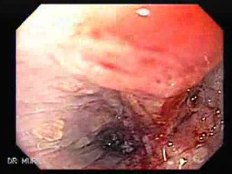Gastric Adenocarcinoma That Has Been Manifested With Hiccups (4 of 5)