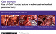Use of Quill® Barbed Suture in Robot-Assisted Radical Prostatectomy - Case Study Prepared by Dr. Luzzago