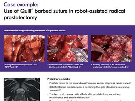 Use of Quill® Barbed Suture in Robot-Assisted Radical Prostatectomy - Case Study Prepared by Dr. Luzzago