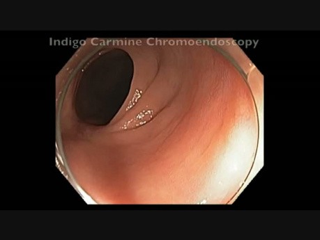 EMR Scar in the Sigmoid Colon - Following a Wide Field EMR in the Sigmoid Colon