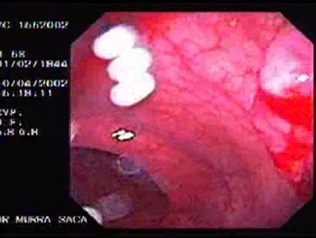 Rectal Cancer That Emerges In The Pectin Line (3 of 3)