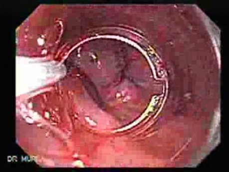 Early Gastric Cancer of the Gastroesophageal Junction - Injection of Solutions to Perform the Mucosectomy