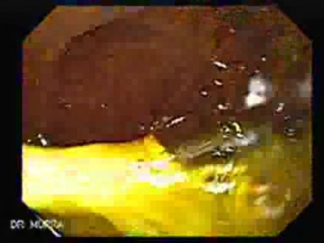 Duodenal Diverticula (1 of 2)