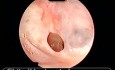 Small Eardrum Perforation of A Tympanic Membrane