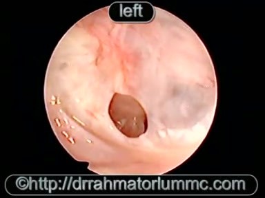 Small Eardrum Perforation of A Tympanic Membrane