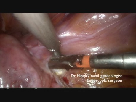 Total Hysterectomy on Frozen Pelvis