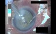 Cataract Surgery 3 - Part 2