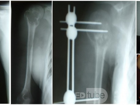 Unicameral Bone Cyst 
