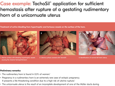 TachoSil® Application for Sufficient Haemostasis After Rupture of a Gestating Rudimentary Horn of a Unicornuate Uterus
