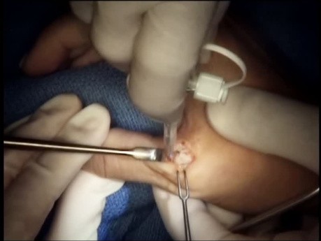 Surgical Repair of Ulnar Collateral Ligament of Thumb