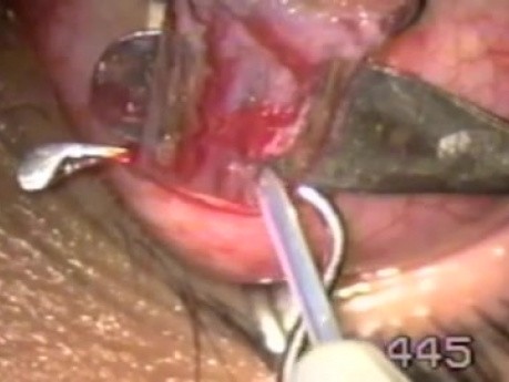Strabismus - Recession Of The Superior Rectus Muscle