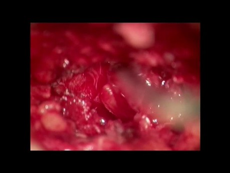 Synovial Cyst on the Lumbar Spine