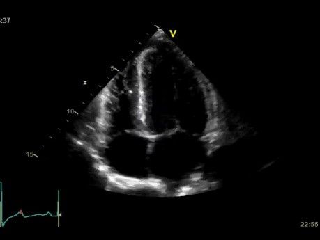 Hypertensive Heart Disease - Cardiomyopathy