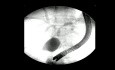 ERCP for Hilar Malignancy