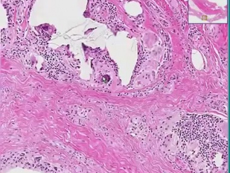 Breast - Foreign body reaction