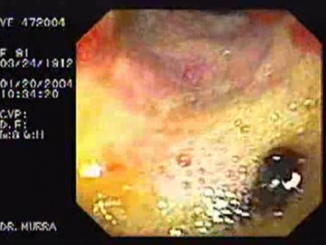 Giant Gastric Ulcer - Endoscopy (1 of 5)