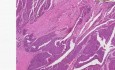 Transitional cell carcinoma - Histopathology - Kidney