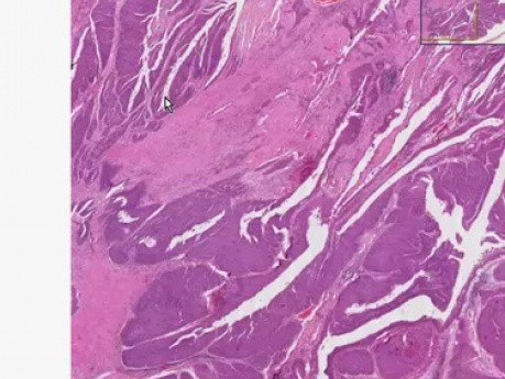 Transitional cell carcinoma - Histopathology - Kidney