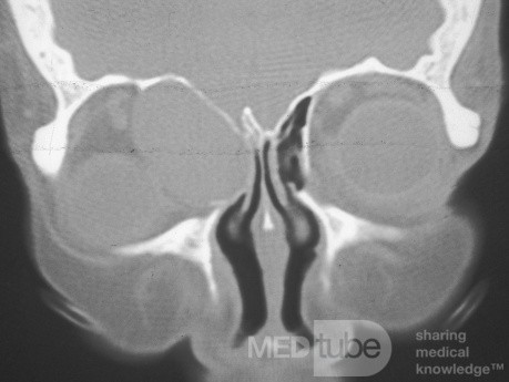 Anterior Ethmoidal Mucocele With Extensive Intraorbital Extension [CT Scan]