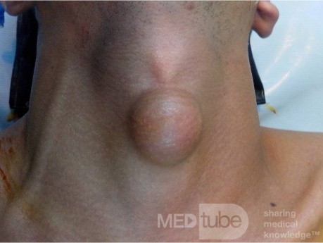 Mid Line Neck Lipoma 