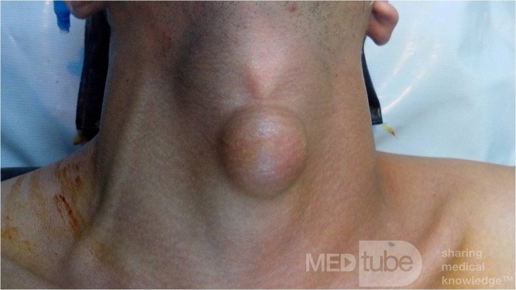 Mid Line Neck Lipoma 