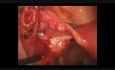 Linear Salpingostomy - Ectopic Tubal Pregnancy
