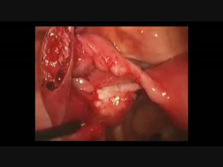 Linear Salpingostomy - Ectopic Tubal Pregnancy