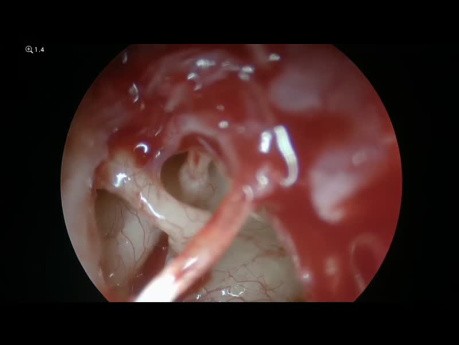 Meniere's Disease - Endoscopic Tenotomies
