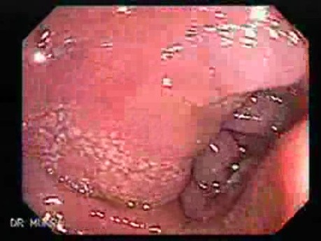 Multiple Adenomatous Polyps Of The Rectum (6 of 37)