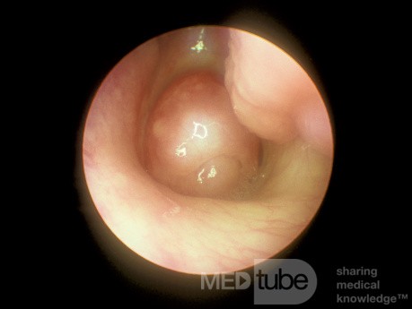 Choanal Polyp
