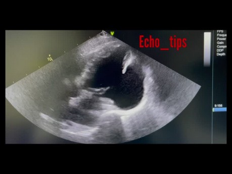 Echocardiography  - What You See?