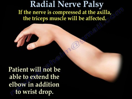 Radial Nerve Palsy - Saturday Night Palsy - Part 1