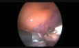 Hysterectomy - Left Side
