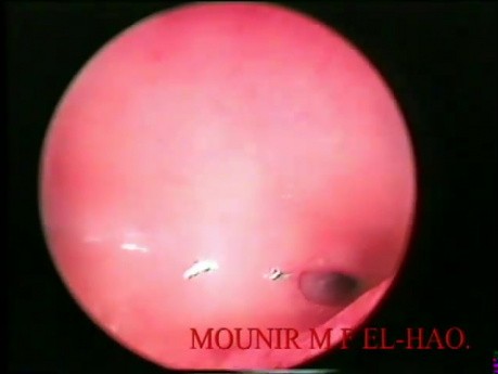 Hysteroscopy for Diagnostic Purposes
