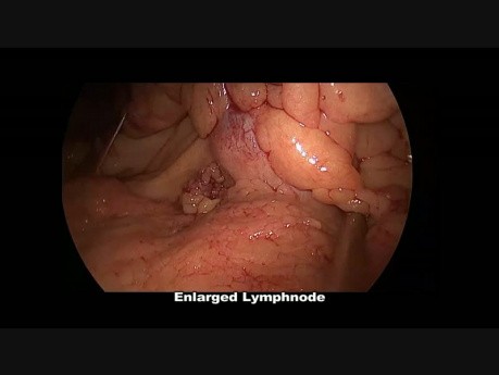 Laparoscopic Right Radical Hemicolectomy for Terminal Ileal NET