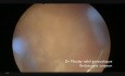 Live Teaching Hysteroscopic Type 1 Myoma Resection