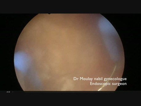 Live Teaching Hysteroscopic Type 1 Myoma Resection