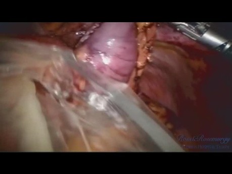 Robotic Near Total Gastrectomy
