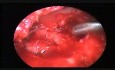 Endoscopic Tympanomastoidectomy with Soft Tissue Reconstruction