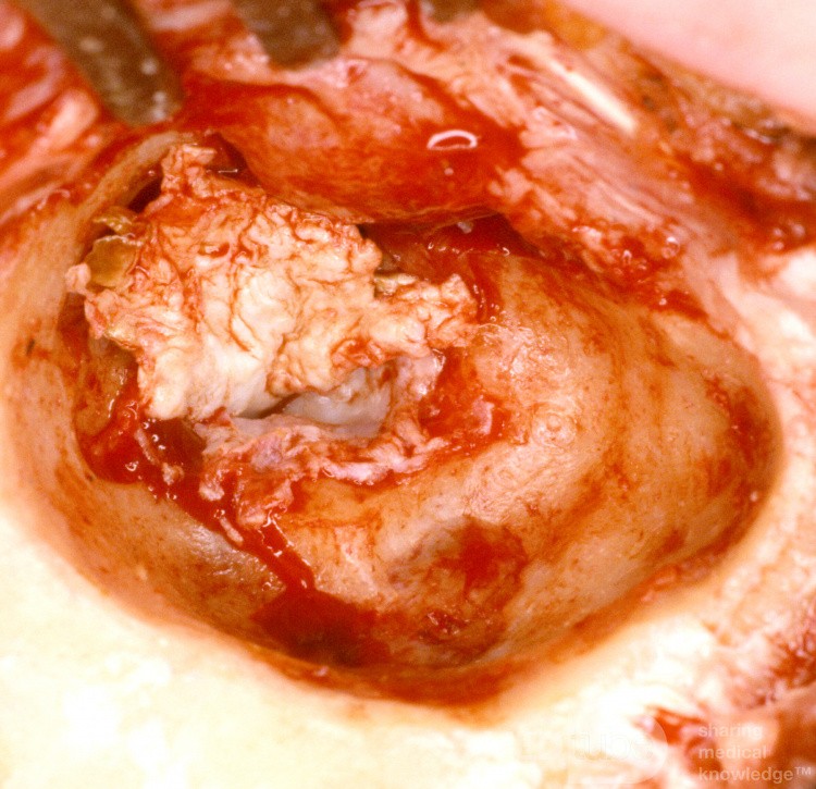 Mastoid Abscess Mastoidectomy