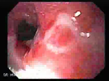 Benign Esophageal Stricture - Result Of GERD