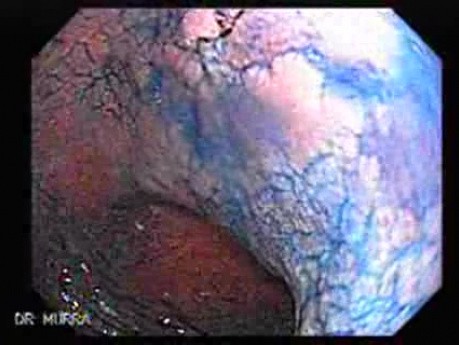 Chronic Gastritis (7 of 8)