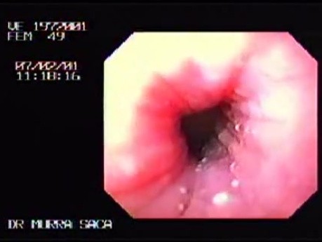 Esophageal Achalasia (3 of 7)
