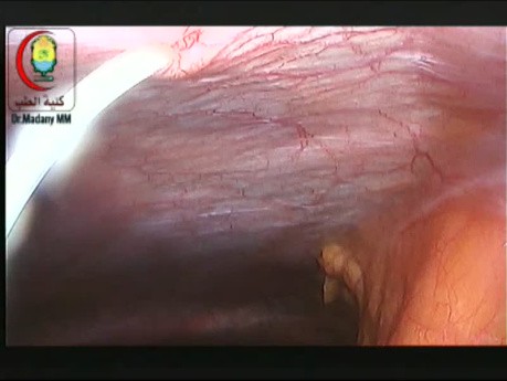 Laparoscopic Surgery in Patients with VP Shunt